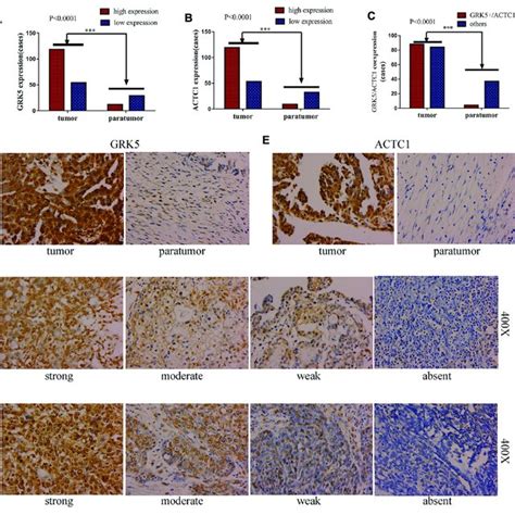 GRK5 And ACTC1 Were Both Upregulated In Paraffin Embedded EOC A
