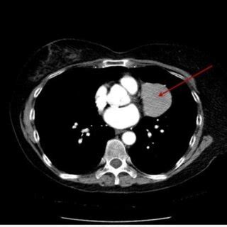 Chest Ct Scan Illustrated A X X Cm Mass Abutting The Left