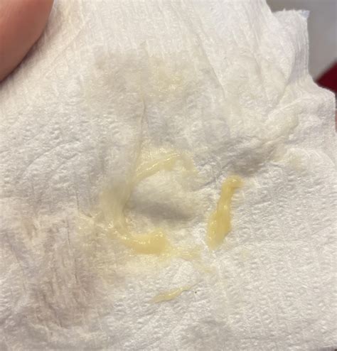 Yellow Discharge for seemingly no reason : r/DiagnoseMe