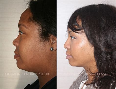 African American Rhinoplasty In Toronto Solomon Facial Plastic