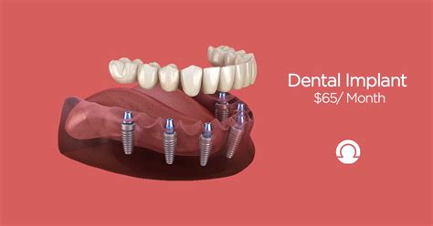 Full Mouth Dental Implants Favourite Dentistry