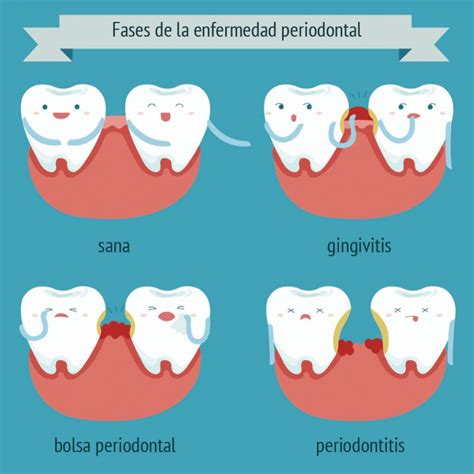 Periodoncia Vitoria Tratamiento Periodintitis En Cabero And López