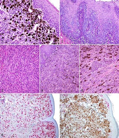 Canine Oral Melanocytic Neoplasm Pigmented Neoplastic Melanocytes