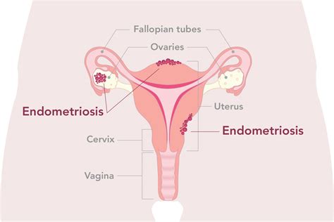 Unpacking Endometriosis