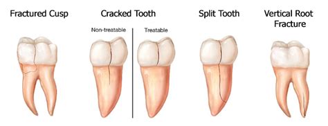 What To Do For A Cracked Tooth Pro Teeth Guard