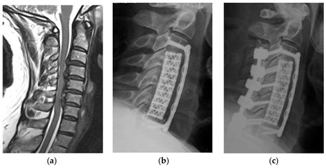 Jcm Free Full Text Radiological And Clinical Outcome After