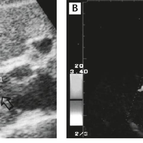 Contrast Enhanced Color Doppler Ultrasound In 2 Cm Focal Nodular