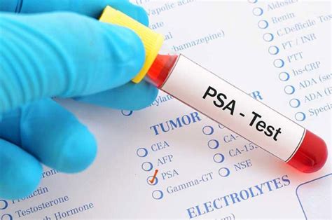 Antígeno prostático específico Radiología La Serena