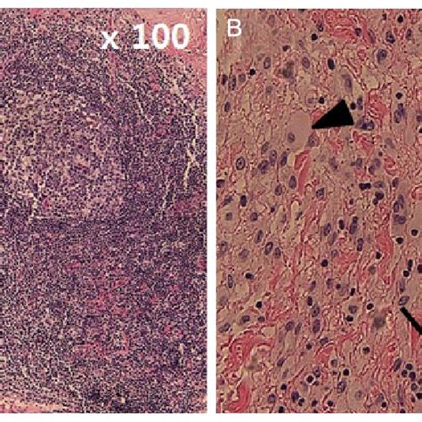 Histopathological Examination Of Mass A Histopathology Shows