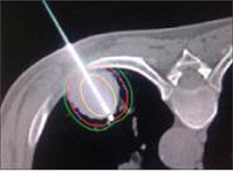 Brachytherapy