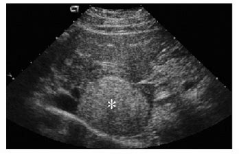 Hemorrhagic hepatocellular adenoma: Ultrasound evaluation. Ultrasound... | Download Scientific ...