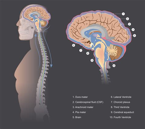 About spinal CSF leak - spontaneous intracranial hypotension — SPINAL CSF LEAK CANADA