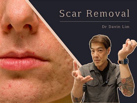 Co Laser Resurfacing For Acne Scars Cutis Dermatology