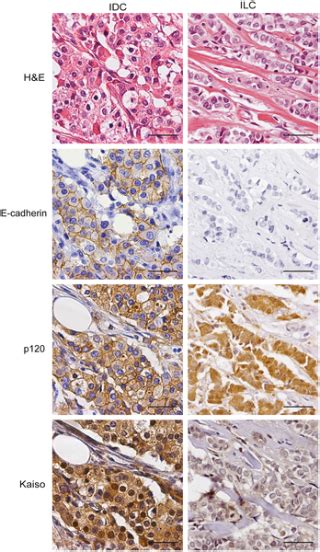 Nuclear Kaiso Expression Is Associated With High Grade And Triple