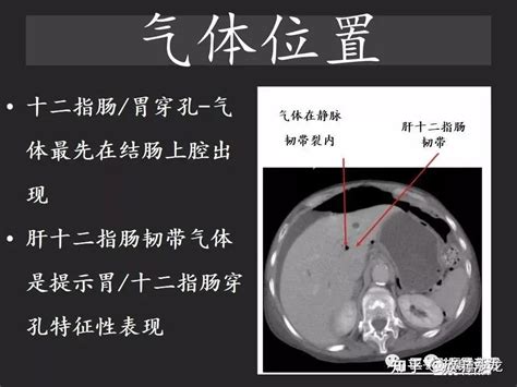 胃肠穿孔：气从哪里来？通过腹膜解剖确定穿孔部位 知乎