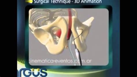 Incontin Ncia Urin Ria No Homem Cirurgia Sling Masculino Argus Youtube