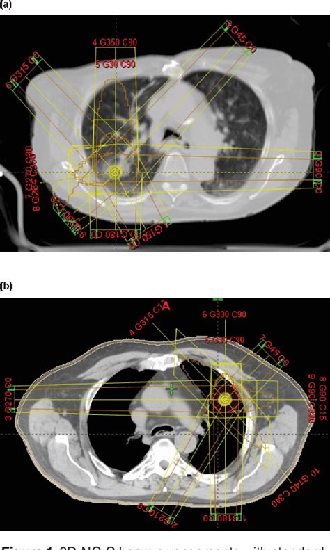 Figure 1 From Off Target Isocentric Approach In Non Coplanar Volumetric