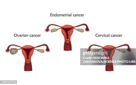 196 Fallopian Tube Cancer Stock Photos, High-Res Pictures, and Images ...