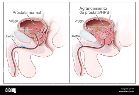 Prostata Hyperplasie Fotos Und Bildmaterial In Hoher Aufl Sung Alamy