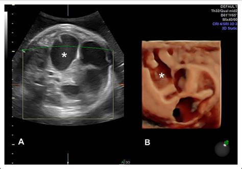 Prenatal Diagnosis Of Jejunal Atresia By 3 D Ultrasonography And Mri