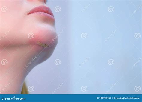 Woman`s Chin With Wound And Burning Skin After Laser Removal Of Scar