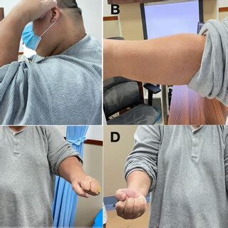 The range of motion 12 months postoperatively: A elbow flexion; B elbow ...