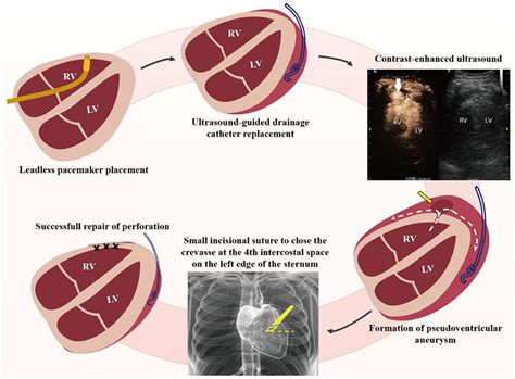 Frontiers Minimally Invasive Repair Of Iatrogenic Right Ventricular