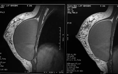 Breast Implants And Lymphoma Breast Surgery Breast Oncology