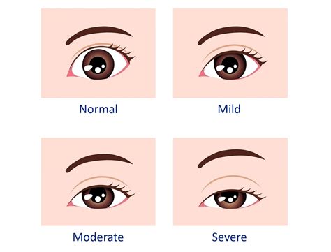 Guide To Droopy Eyelid Ptosis Treatment In Singapore Dream Plastic