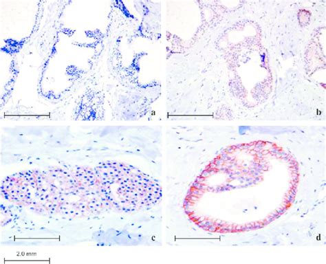 Cyclooxygenase-2 staining patterns in atypia. Representative breast... | Download Scientific Diagram