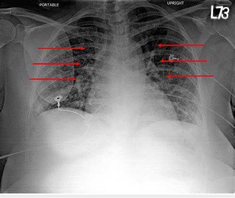 Chest X Ray Showing Enlarged Cardiac Silhouette With Interstitial