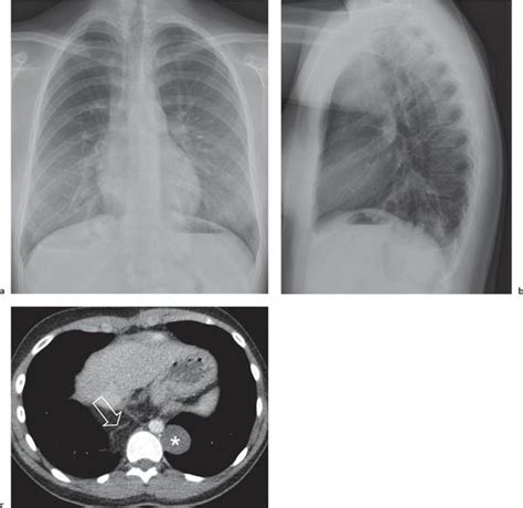 Mediastinum The Mediastinum Radiology Key