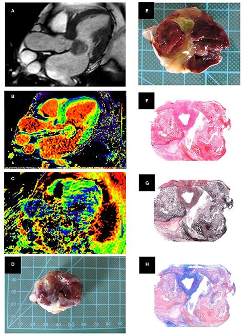 Frontiers Cardiac Myxomas Show Elevated Native T1 T2 Relaxation Time