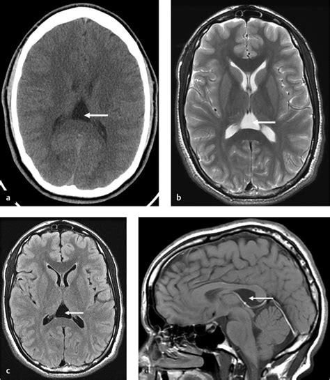 5 Cavum Septum Pellucidum | Radiology Key