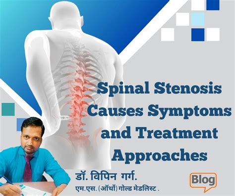 Great Knowledge Spinal Stenosis Causes Symptoms And Treatment