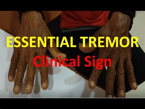 Essential Tremor Fine Tremor Clinical Sign Neurology YouTube