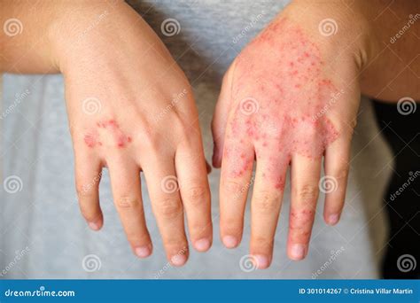 Unrecognizable Woman With Eczema On Hands Atopic Dermatitis Stock