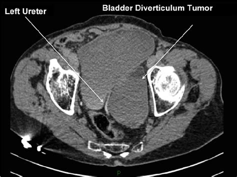 Figure 1 From Robot Assisted Laparoscopic Bladder Diverticulectomy And