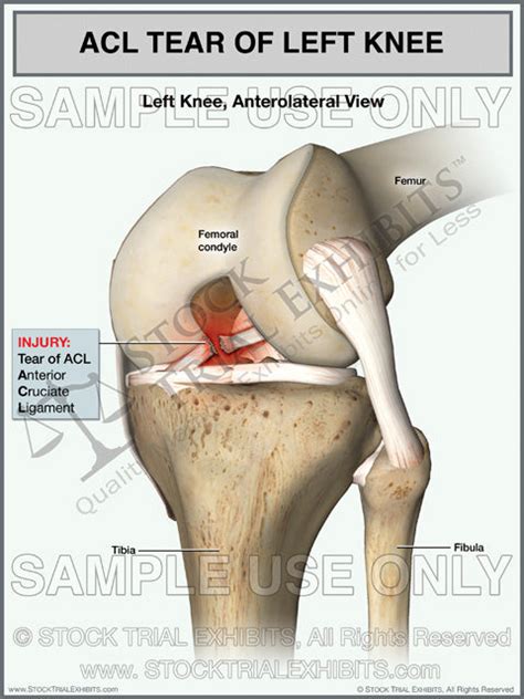 Acl Tear Of The Left Knee Stock Trial Exhibits