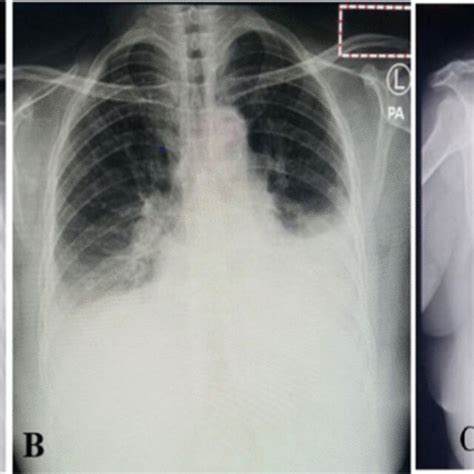 Serial Chest X Ray Images A Symmetrical Bilateral Pleural Effusion B