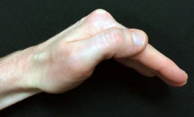 Active Exercise for Finger MP Joint Flexion | HandLab Resources