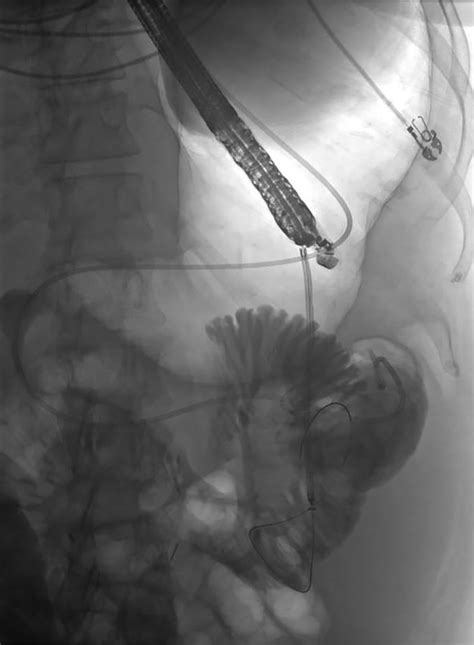 Eus Guided Gastrojejunostomy And Hepaticogastrostomy For Malignant