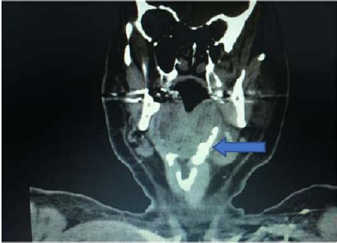 Figure 1 From Eagle Syndrome Unmasked By Acute Parotitis Semantic Scholar