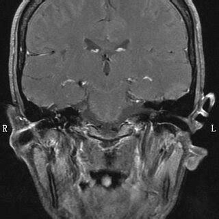 Initial T1 Weighted Gadolinium MRI Showing Prominent Enhancement Within