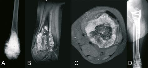 Orthoforum Operationstechniken Zur Weiten Tumorresektion B Sartiger Tumore