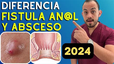 Absceso Y Fistula Anorrectal Diferencias Diagnostico Y Tratamiento