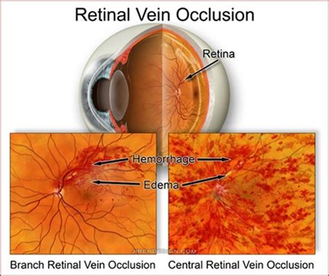 Central Retinal Vein Occlusion - Information on Eye Conditions