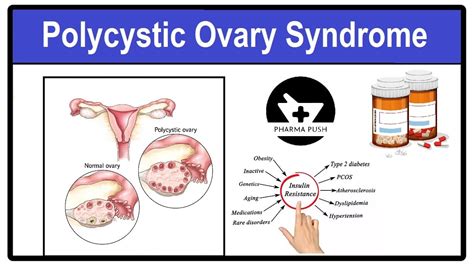 What the first sign of PCOS, symptoms and treatment - PHARMA PUSH