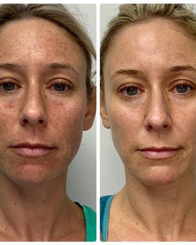 Ipl Photofacial Boca Raton And Fort Lauderdale Ipl Facial