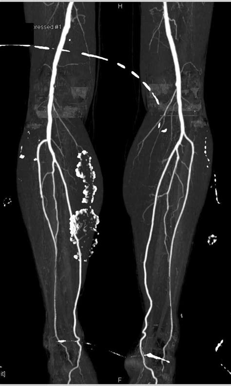 Fem Fem Bypass Graft With Left Superficial Femoral Artery Sfa